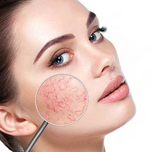 Rougeurs, couperose, angiomes
