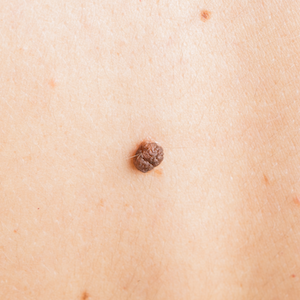 Kératoses séborrhéiques